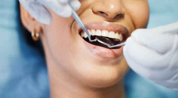 Best Emergency Dentist for Lost Fillings or Crowns in Auburn, WA